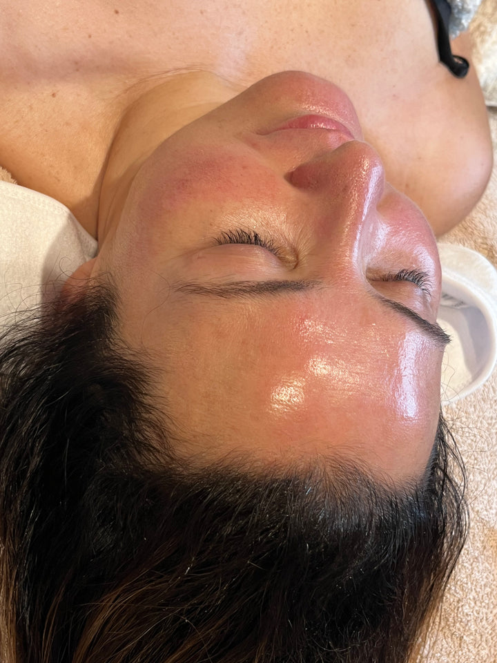 Microneedling i Sandefjord hos Studio L