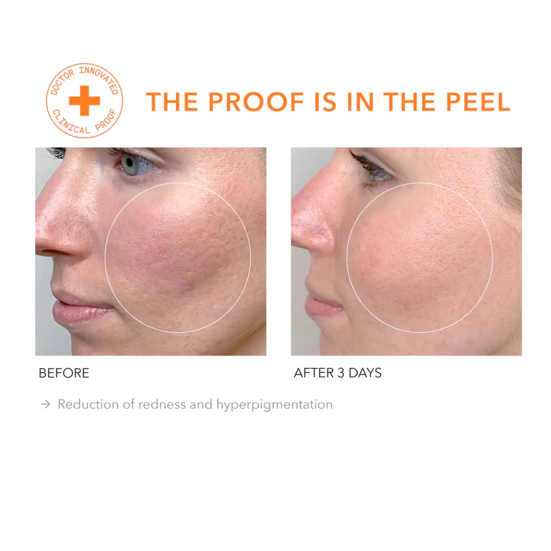 Alpha Beta Daily Peel Extra Strength 5stk