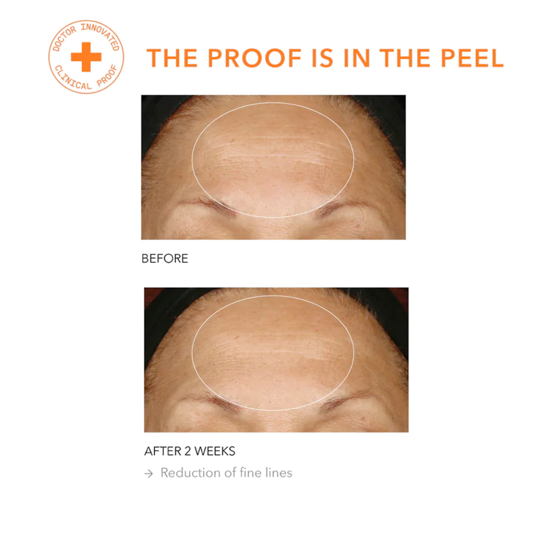 Alpha Beta Daily Peel Extra Strength 5stk