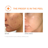 Alpha Beta Daily Peel Extra Strength 5stk