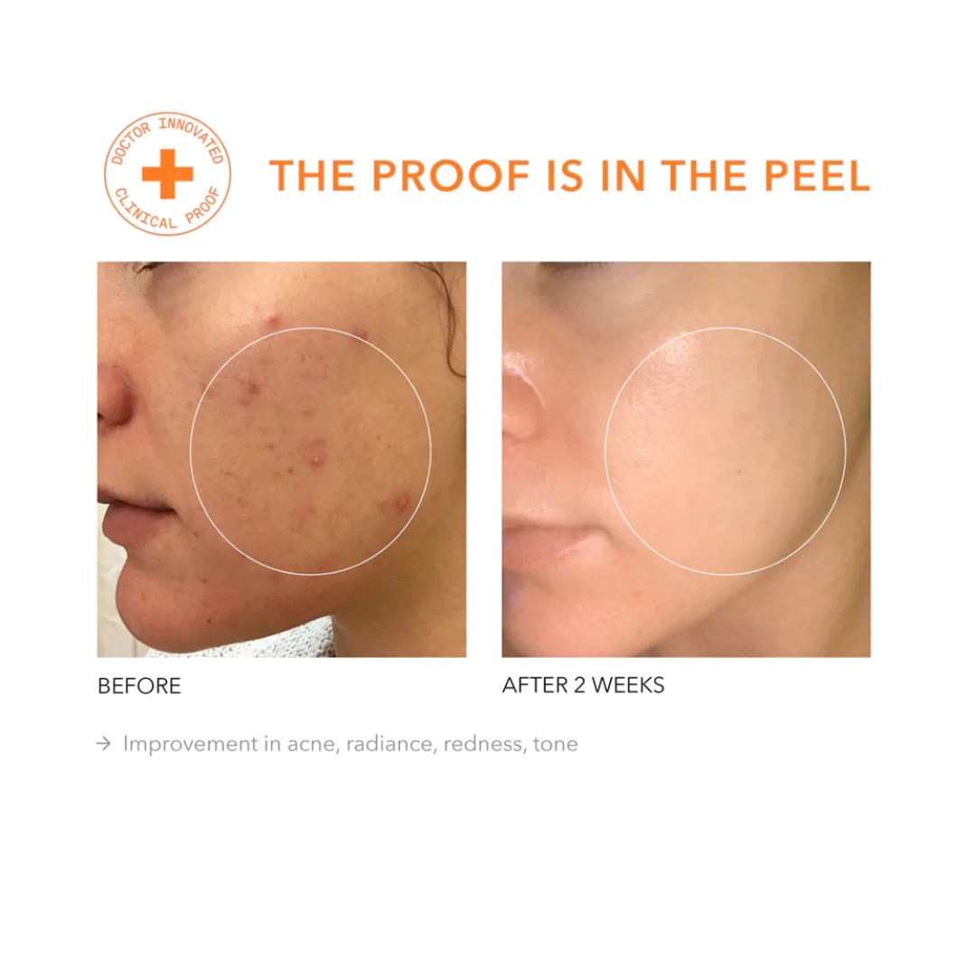 Alpha Beta Daily Peel Extra Strength